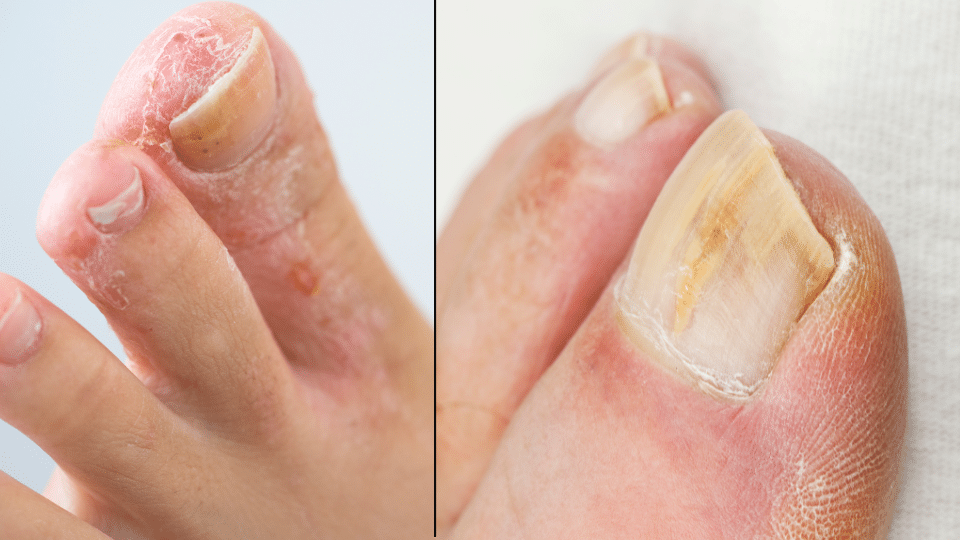 difference between athlete's foot and toenail fungus
