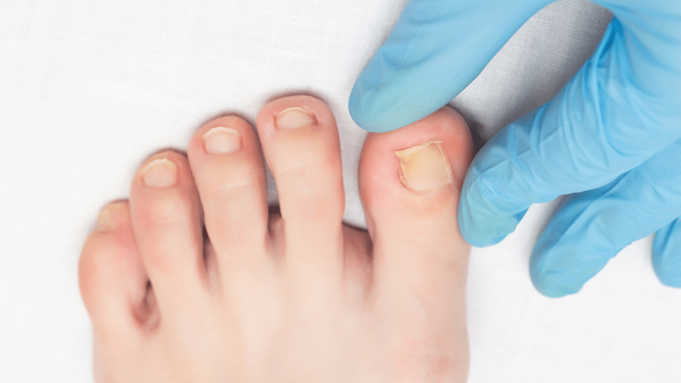 ingrown toenail doctor