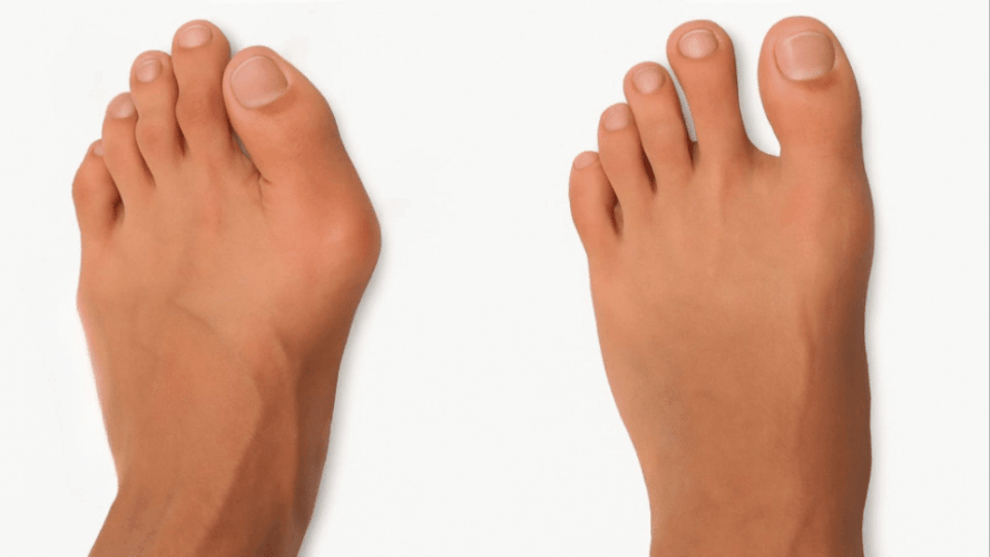 hammer toe