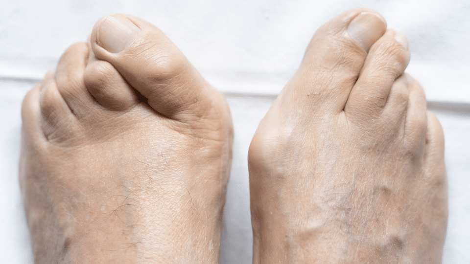 what is hammer toe​