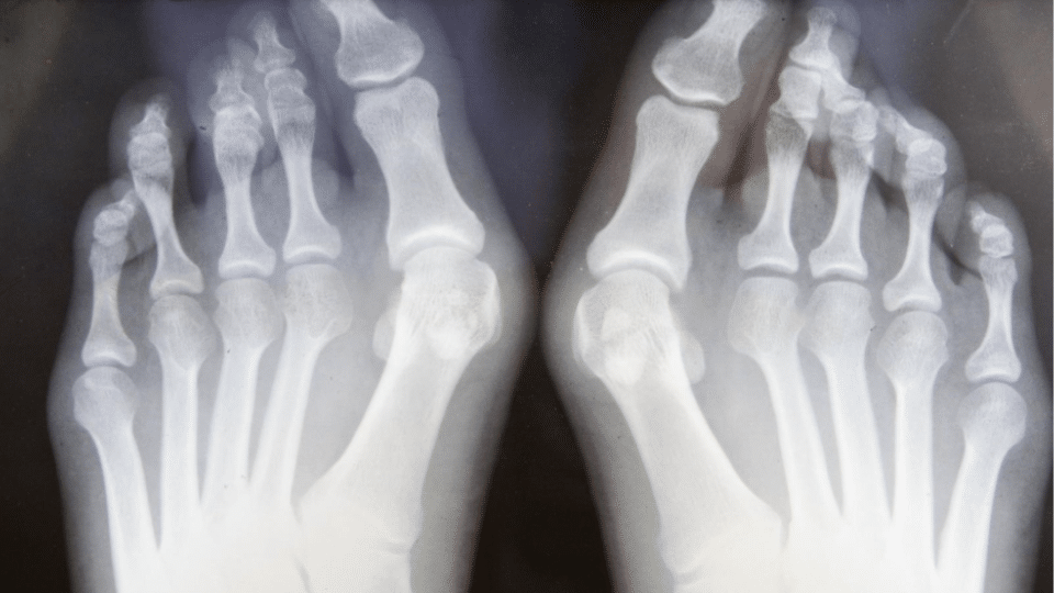 are bunions genetic