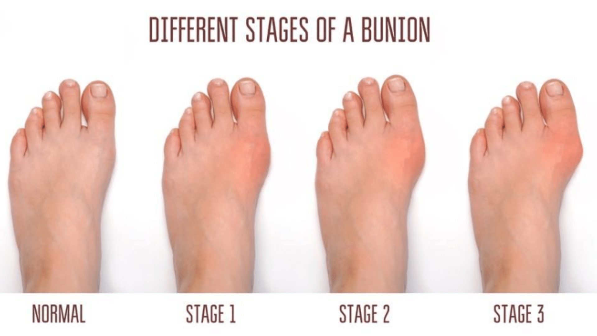 signs of a bunion - different stages