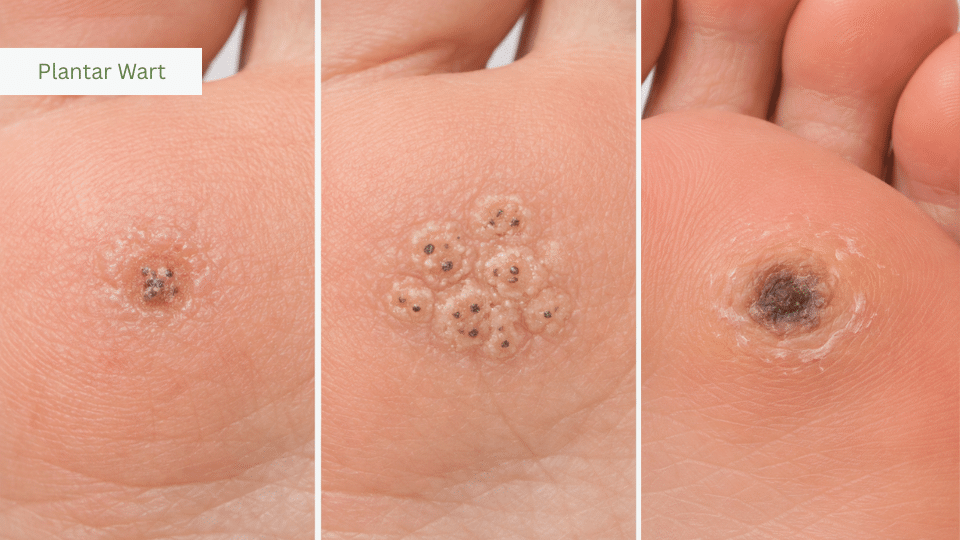 Plantar wart examples on foot showing different appearances
