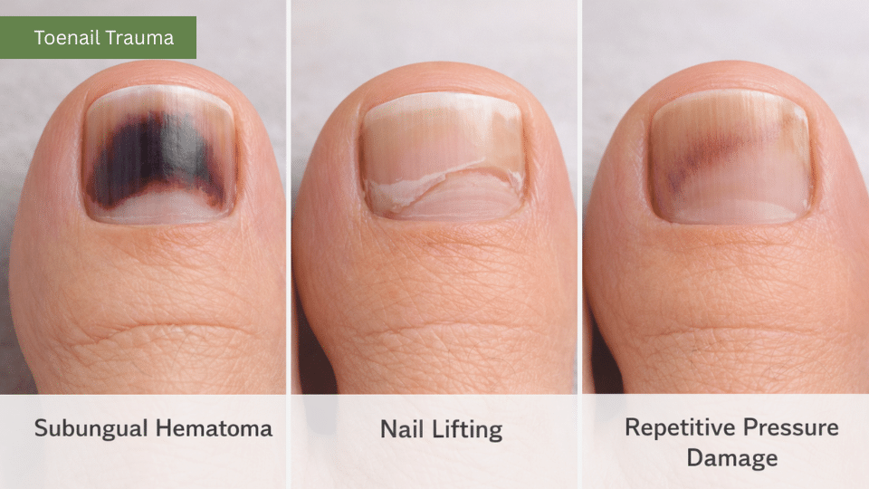 Toenail trauma examples bruising lifting pressure damage in a blog about toenail trauma vs fungus