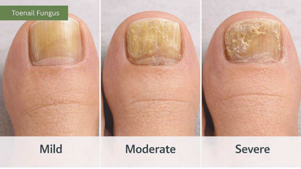 Toenail fungus stages mild moderate severe comparison in the blog about toenail trauma vs fungus
