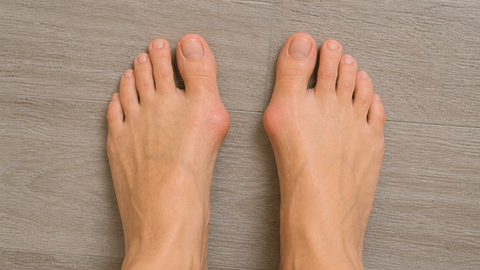 Top view of feet showing bunion at big toe joint with mild redness